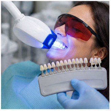Professional teeth whitening